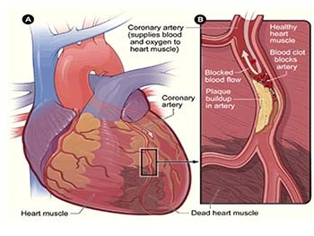 Nutritional Management of Diabetes And Heart Diseases