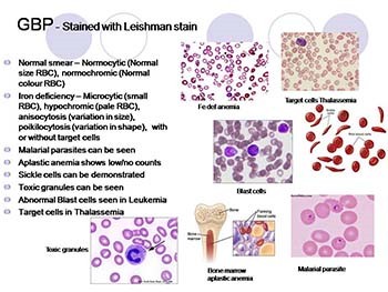 Anemia in Pregnancy