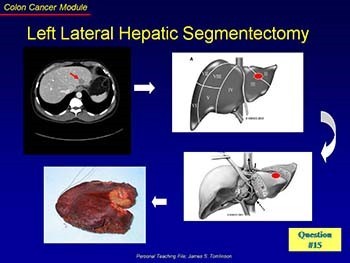 Colon Cancer-Epidemiology Treatment and Survival