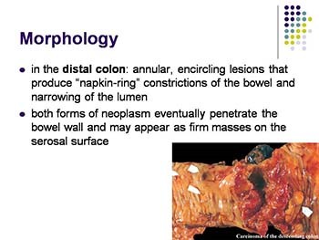 Colorectal Carcinoma