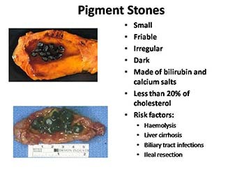 Gall Stone disease-Etiology Clinical features diagnosis Complications