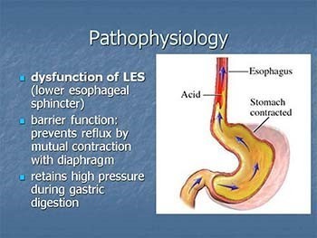 GastroEsophageal Reflux Disease (GERD)