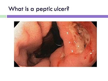 Peptic ulcer disease