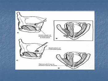 CONGENITAL LARYNGEAL DISEASE AND VOICE DISORDERS