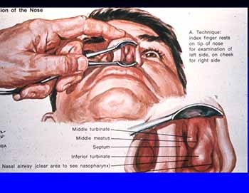 Acute Sinusitis - Diagnosis Management and Complications