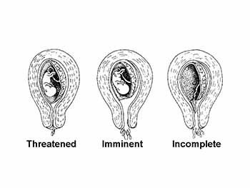 Spontaneous abortion