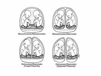 Multiple Pregnancy