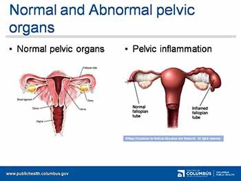 Pelvic Inflammatory Disease