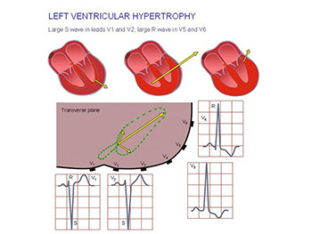 Antihypertensive Drugs