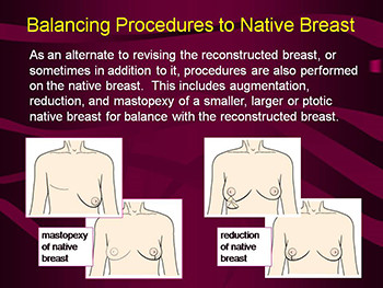 Diagnosis Coding For Staged Breast Reconstruction Encounters