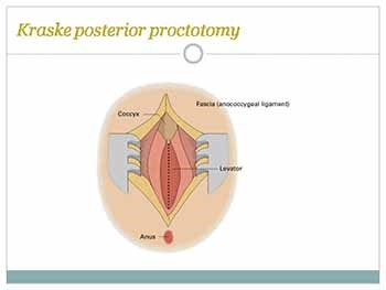 Colorectal Cancer Surgery