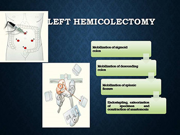 Laparoscopic colorectal surgery