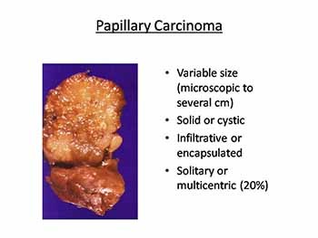 Thyroid Neoplasms