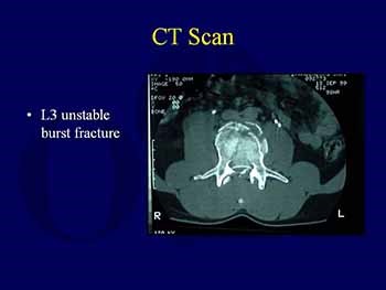 Thoracic and Lumbar Spine Fractures and Dislocations