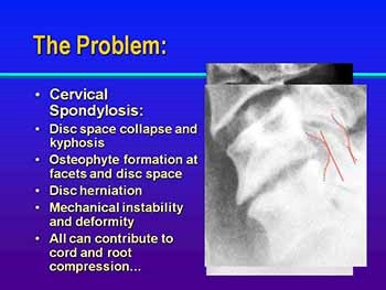 Neck and Arm Pain-The Result of Long-Standing Wear and Tear on the Cervical Spine