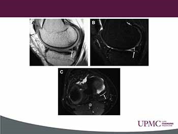 Meniscus Injuries