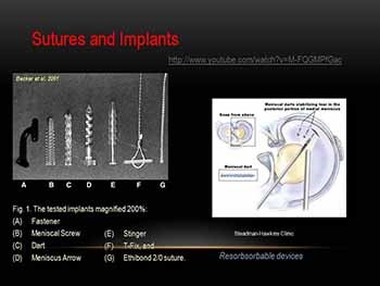 Meniscal Repair