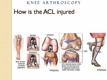 Anterior Cruciate Ligament Reconstruction