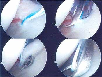 Acute anterior dislocation of the shoulder