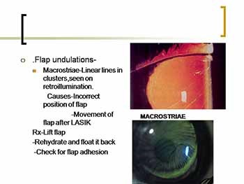 REFRACTIVE SURGERIES