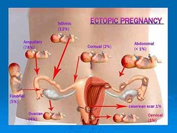 CLINICAL PRESENTATION OF A CASE PID TURNED OUT TO BE ECTOPIC PREGNANCY