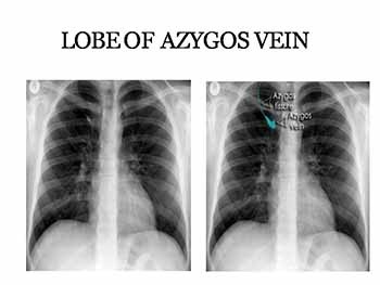 THORAX RADIOLOGY