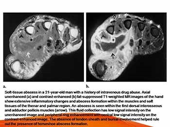 Imaging Findings in Musculoskeletal Complications of AIDS