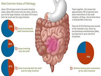 Inflammatory bowel disease imaging