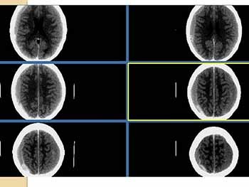 Brain Imaging in Trauma