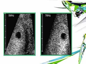 FIRST TRIMESTER ULTRASOUND