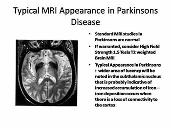 Rehabilitation Management of Parkinsons Disease