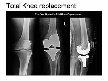 ROLE OF PHYSIOTHERAPY IN ORTHOPAEDICS