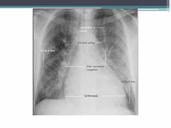 Heart Failure in pediatrics