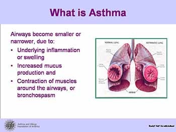 Exercise-Induced Asthma