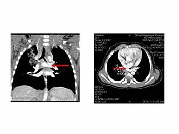 Acute severe asthma in children