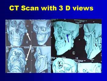 WHAT IS NEW IN HEAD AND NECK CANCERS