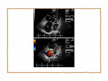 Eisenmenger Syndrome