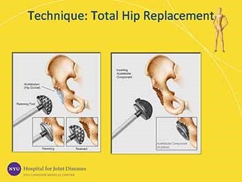 Arthritis of the Hip