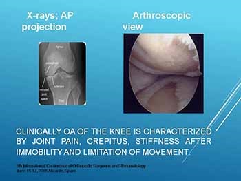 An Algorithm of the Management of Knee Osteoarthritis (OA)