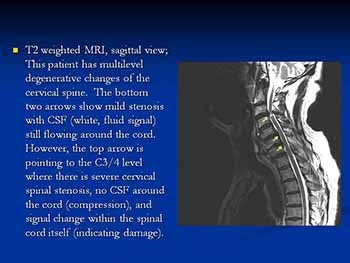 Online Module-Spine