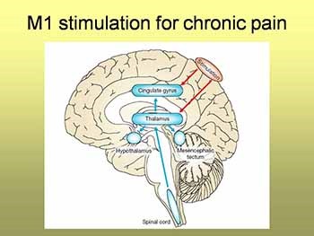 Neuromodulation for chronic pain