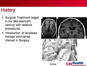 Deep Brain Stimulation-A Proven Treatment for Movement Disorders