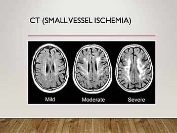 The Benefits of Neuropsychological Assessment in the Diagnosis and Treatment of Brain Injury