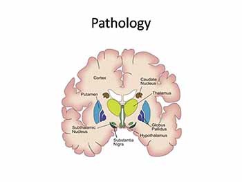 Idiopathic parkinsons disease (IPD)