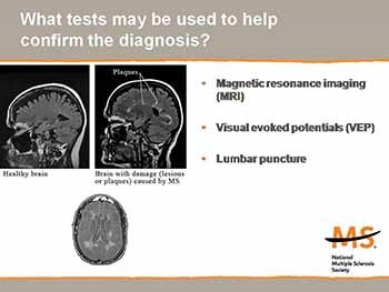 Multiple Sclerosis-What You Need to Know About the Disease