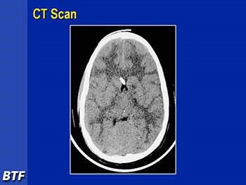 Management of Severe Traumatic Brain Injury