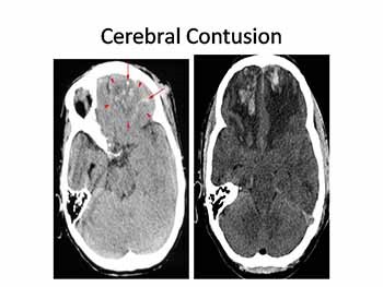 Head Injury-Assessment and Management