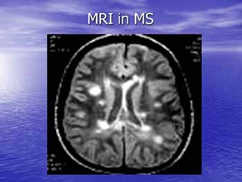 DEMYELINATING DISEASE MULTIPLE SCLEROSIS