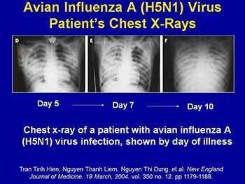 Case Management of Suspect Avian Influenza A (H5N1) Virus Infection in Humans