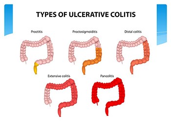 Ulcerative Colitis